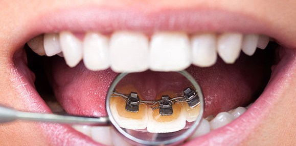 lingual-ortodonti-gorunmeyen-dis-telleri-hakkinda-merak-edilenler_20180622143910