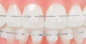 porselen-braketler-300x163