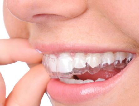 telsiz_ortodontik_tedavi_2-700x500