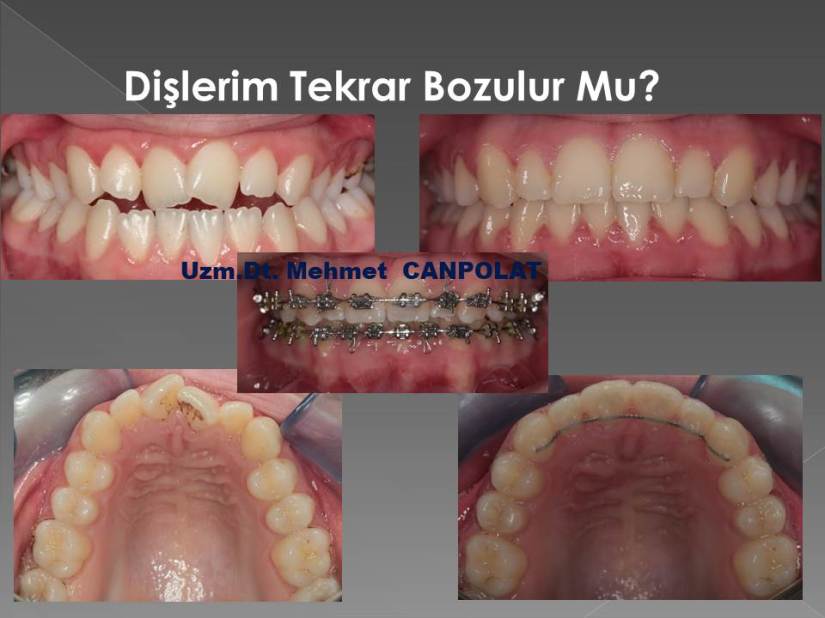retainer begüm