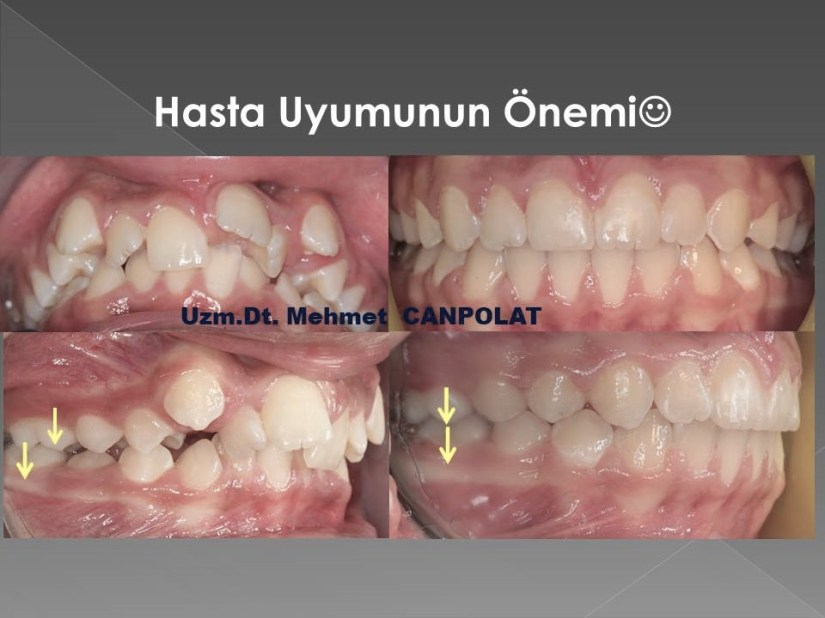 servikal headgear1.jpg